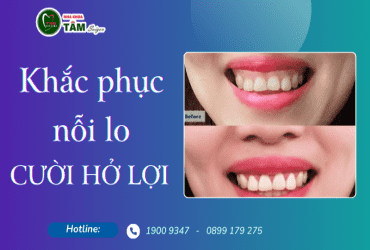 KHẮC PHỤC NỖI LO CƯỜI HỞ LỢI 