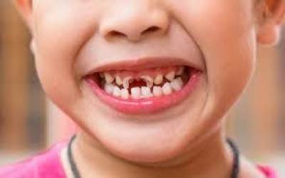 VÌ SAO PHẢI ĐIỀU TRỊ TỦY RĂNG TRẺ EM?
