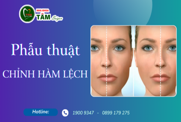 PHẪU THUẬT CHỈNH HÀM LỆCH 