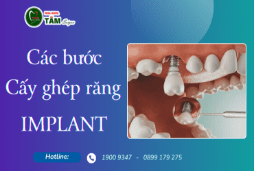 CÁC BƯỚC CẤY GHÉP RĂNG IMPLANT 