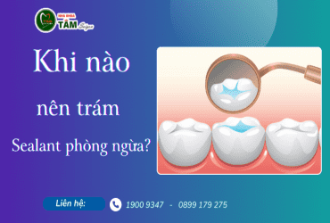 KHI NÀO NÊN TRÁM SEALANT PHÒNG NGỪA? 