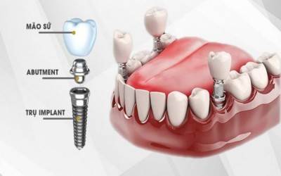 KỸ THUẬT CẤY GHÉP IMPLANT NHƯ THẾ NÀO?