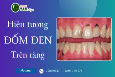 HIỆN TƯỢNG ĐỐM ĐEN TRÊN RĂNG 