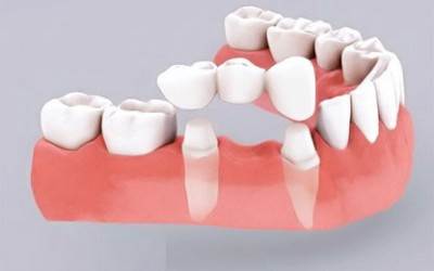 NHỮNG TRƯỜNG HỢP NÊN LÀM CẦU RĂNG SỨ 