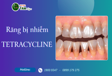 RĂNG BỊ NHIỄM TETRACYCLINE 