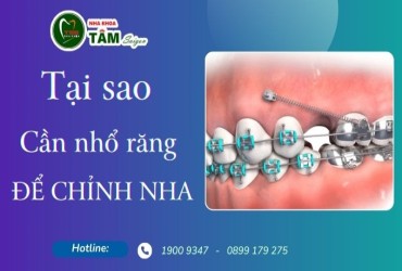 TẠI SAO CẦN NHỔ RĂNG ĐỂ CHỈNH NHA