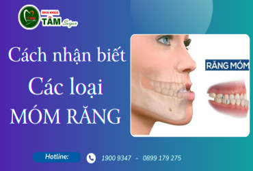 CÁCH NHẬN BIẾT CÁC LOẠI MÓM RĂNG 