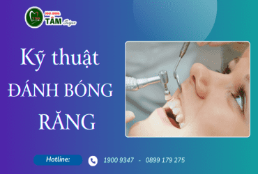 KỸ THUẬT ĐÁNH BÓNG RĂNG 