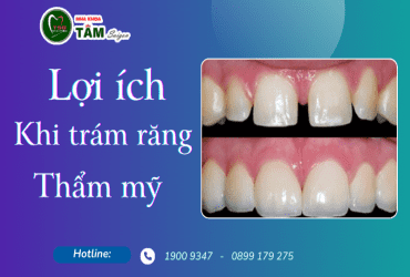 LỢI ÍCH CỦA TRÁM RĂNG THẨM MỸ 