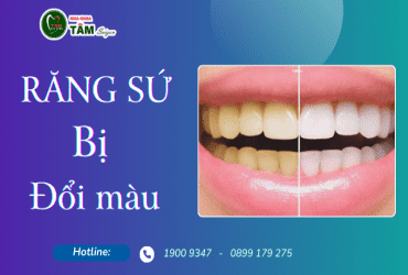 RĂNG SỨ BỊ ĐỔI MÀU 