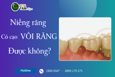 NIỀNG RĂNG CÓ LẤY VÔI RĂNG ĐƯỢC KHÔNG?