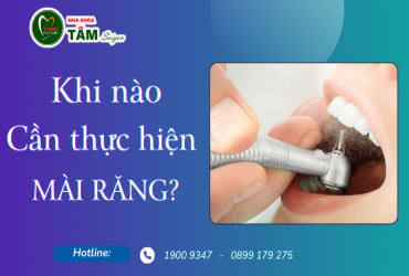 KHI NÀO CẦN THỰC HIỆN MÀI RĂNG?