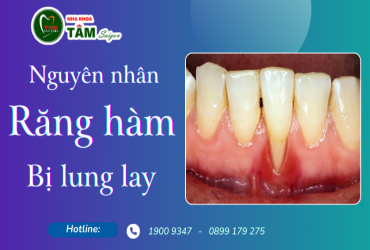 NGUYÊN NHÂN RĂNG HÀM BỊ LUNG LAY 