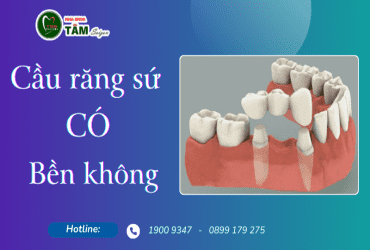 CẦU RĂNG SỨ CÓ BỀN KHÔNG? 