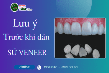 LƯU Ý TRƯỚC KHI DÁN SỨ VENEER 