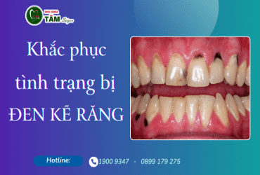 KHẮC PHỤC TÌNH TRẠNG BỊ ĐEN KẼ RĂNG 