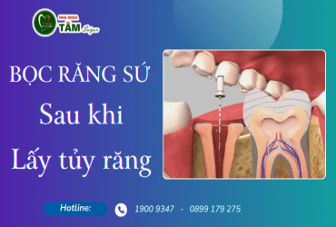 BỌC RĂNG SỨ SAU KHI LẤY TỦY RĂNG 