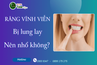 RĂNG VĨNH VIỄN BỊ LUNG LAY CÓ NÊN NHỔ KHÔNG?