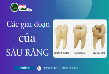 CÁC GIAI ĐOẠN CỦA SÂU RĂNG 