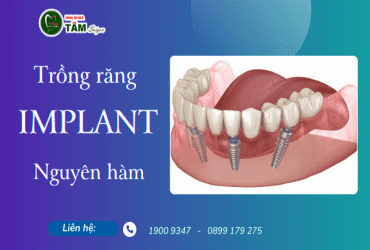 TRỒNG RĂNG IMPLANT NGUYÊN HÀM 