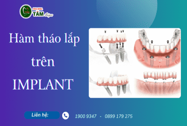 HÀM THÁO LẮP TRÊN IMPLANT 