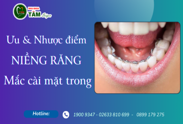 ƯU NHƯỢC ĐIỂM CỦA NIỀNG RĂNG MẮC CÀI MẶT TRONG 