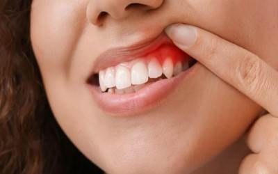ĐIỀU TRỊ SƯNG NƯỚU RĂNG NHƯ THẾ NÀO? 