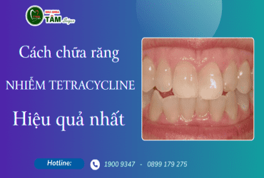 CÁCH CHỮA RĂNG TETRACYCLINE HIỆU QUẢ NHẤT