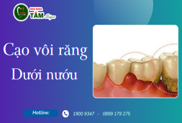 CẠO VÔI RĂNG DƯỚI NƯỚU 