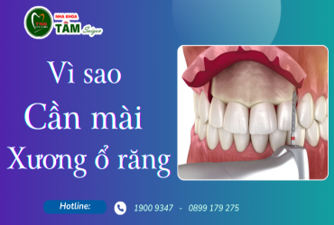 VÌ SAO CẦN MÀI XƯƠNG Ổ RĂNG?