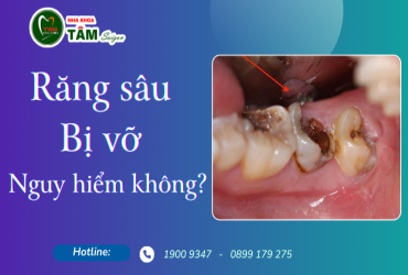 SÂU RĂNG BỊ VỠ CÓ NGUY HIỂM KHÔNG?