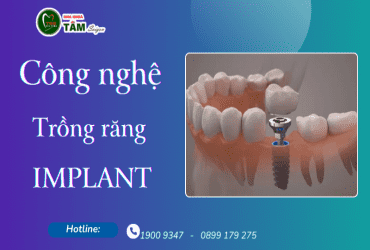 CÔNG NGHỆ TRỒNG RĂNG IMPLANT 