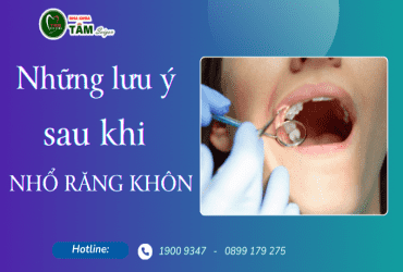 NHỮNG LƯU Ý SAU KHI NHỔ RĂNG KHÔN 