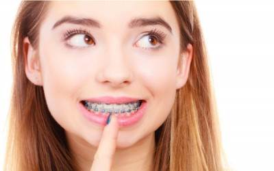 KINH NGHIỆM VỀ NIỀNG RĂNG MẮC CÀI MÀ BẠN NÊN BIẾT