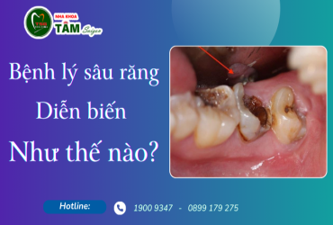 BỆNH LÝ SÂU RĂNG DIỄN BIẾN NHƯ THẾ NÀO?