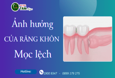 ẢNH HƯỞNG CỦA RĂNG KHÔN MỌC LỆCH 