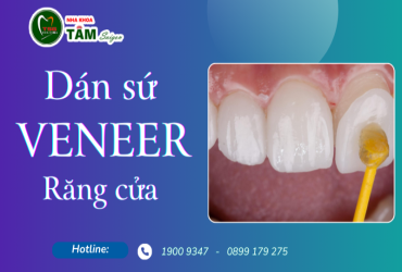 DÁN SỨ VENEER RĂNG CỬA