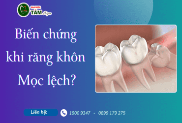 BIẾN CHỨNG NGUY HIỂM KHI RĂNG KHÔN MỌC LỆCH, NGẦM 