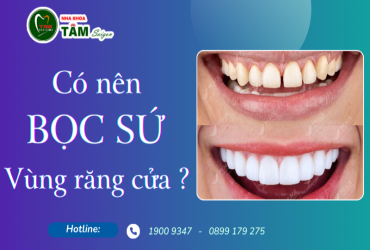 CÓ NÊN BỌC SỨ VÙNG RĂNG CỬA ?