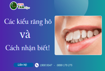 CÁC KIỂU RĂNG HÔ VÀ CÁCH NHẬN BIẾT 