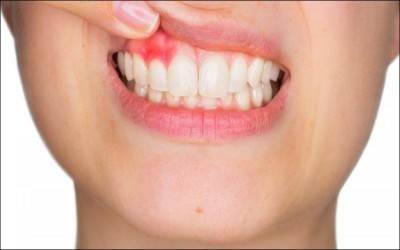 BỆNH NHA CHU LÀ GÌ? NHỮNG ĐIỀU BẠN CẦN BIẾT VỀ BỆNH NHA CHU 