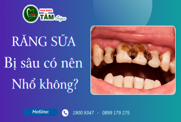 RĂNG SỮA BỊ SÂU CÓ NÊN NHỔ KHÔNG?