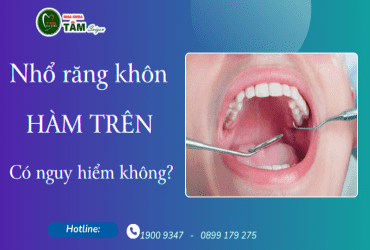 NHỔ RĂNG KHÔN HÀM TRÊN CÓ NGUY HIỂM KHÔNG?