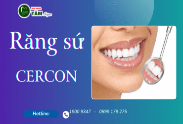 RĂNG SỨ CERCON LÀ GÌ?