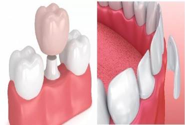 NÊN CHỌN BỌC RĂNG SỨ HAY DÁN SỨ VENEER?