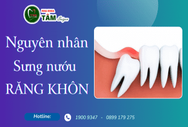 NGUYÊN NHÂN SƯNG NƯỚU RĂNG KHÔN 