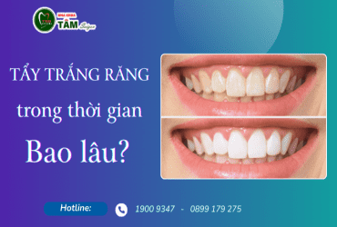 TẨY TRĂNG RĂNG TRONG THỜI GIAN BAO LÂU? 