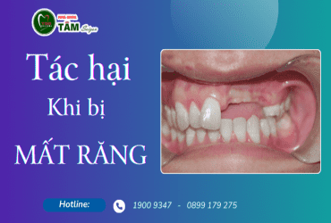 TÁC HẠI CỦA VIỆC MẤT RĂNG 