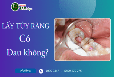 LẤY TỦY RĂNG CÓ ĐAU KHÔNG?