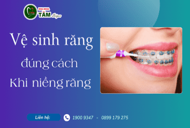 VỆ SINH RĂNG MIỆNG ĐÚNG CÁCH KHI ĐANG NIỀNG RĂNG? 